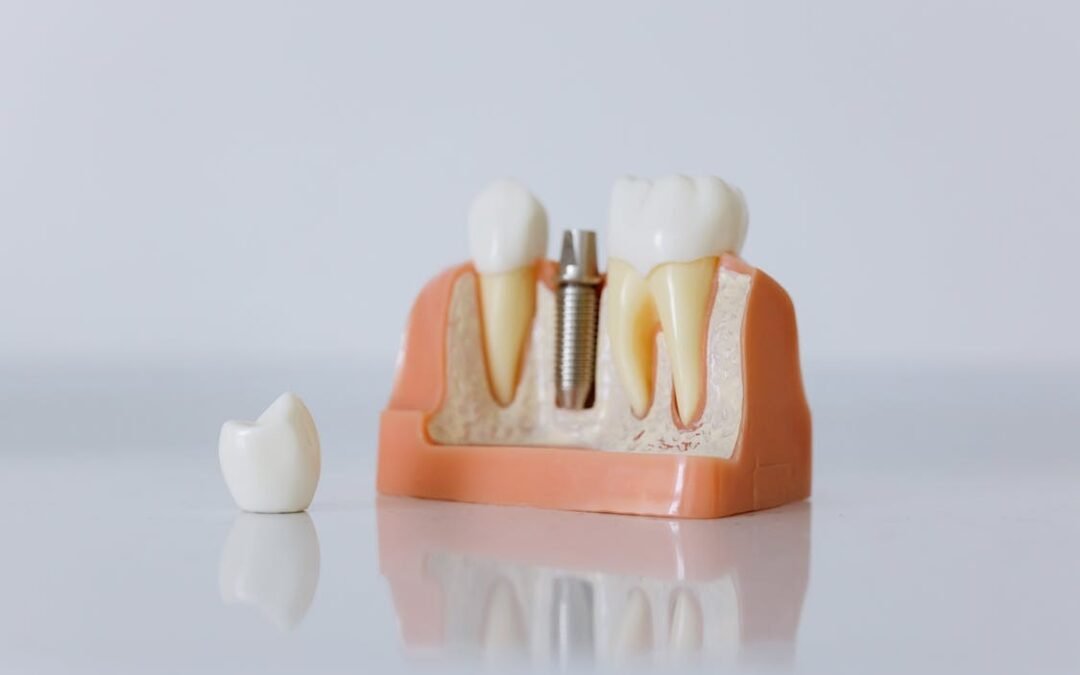 Do Dental Implants Hurt? What to Expect Before, During & After