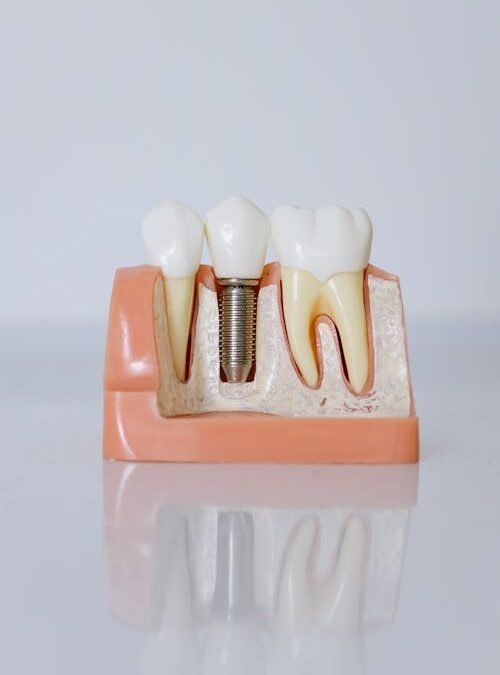 Questions to Ask Before Getting Dental Implants