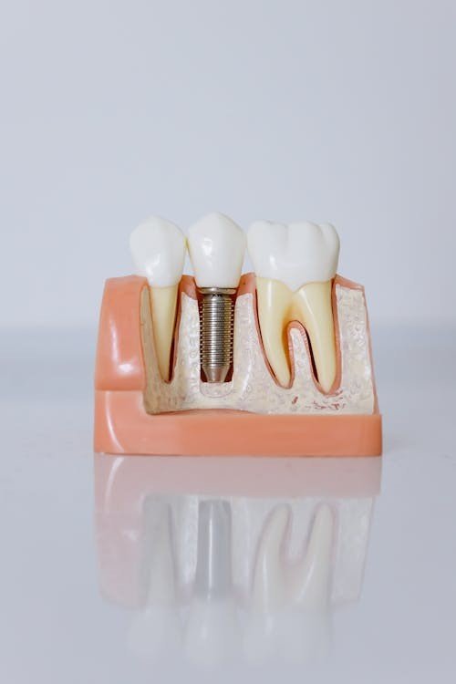 Questions to ask before dental implants - dentist consultation Miramar FL